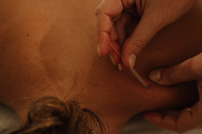 Dry Needling